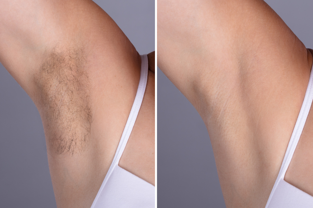 Before And After Concept Of Underarm Hair Removal