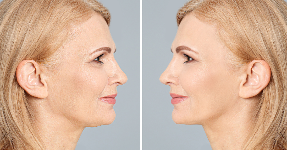Beautiful mature woman before and after biorevitalization procedure on grey background