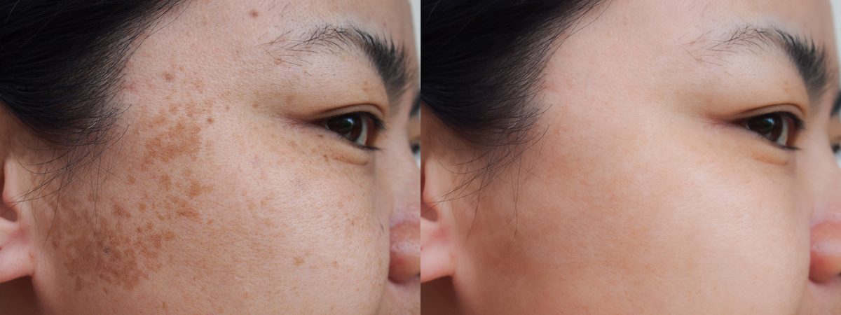 Closeup asian woman face before and after dark spot melasma pigmentation skin facial treatment.Problem skincare and health concept.