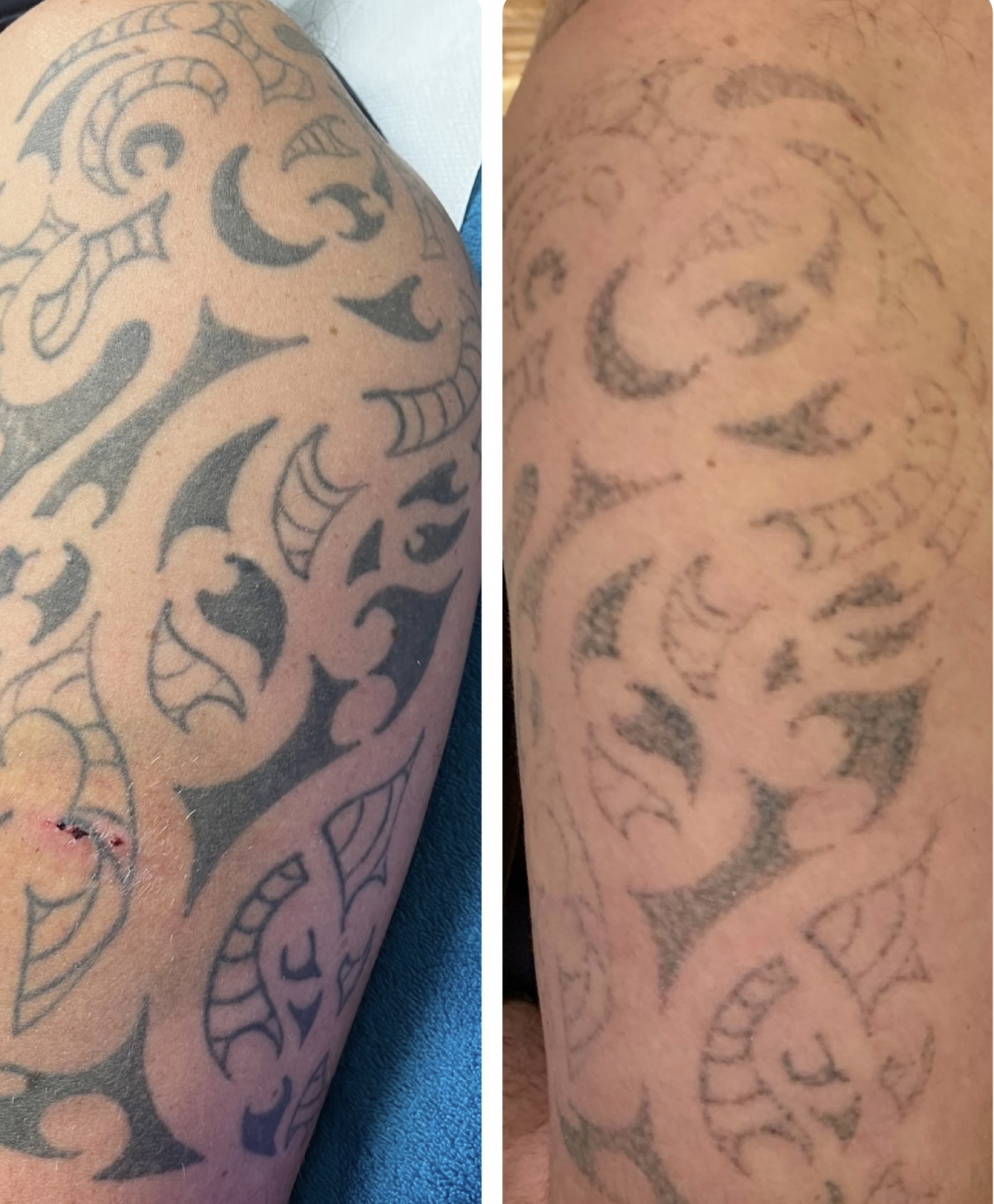 Laser Tattoo Removal - Hayley's Hair Removal and Aesthetics - Poole