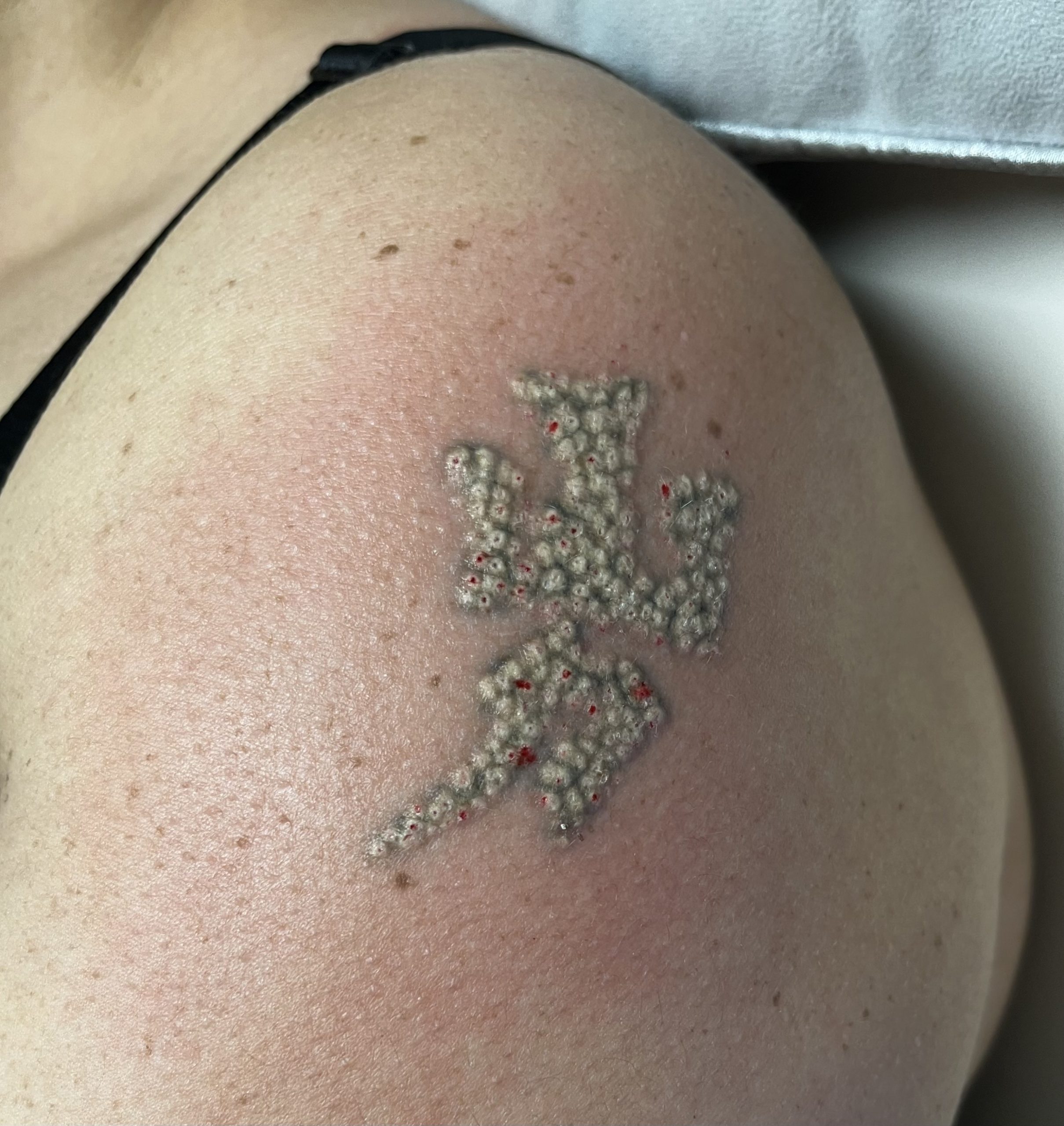 How Does Laser Tattoo Removal Work? - Eraze Clinic - Eraze Laser Clinic